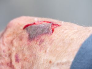 fresh wound