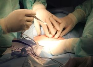 open surgery