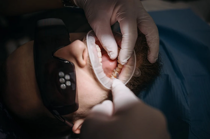 Tooth Reduction